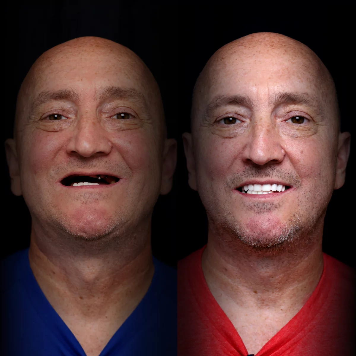 all-on-x-before-after (10)