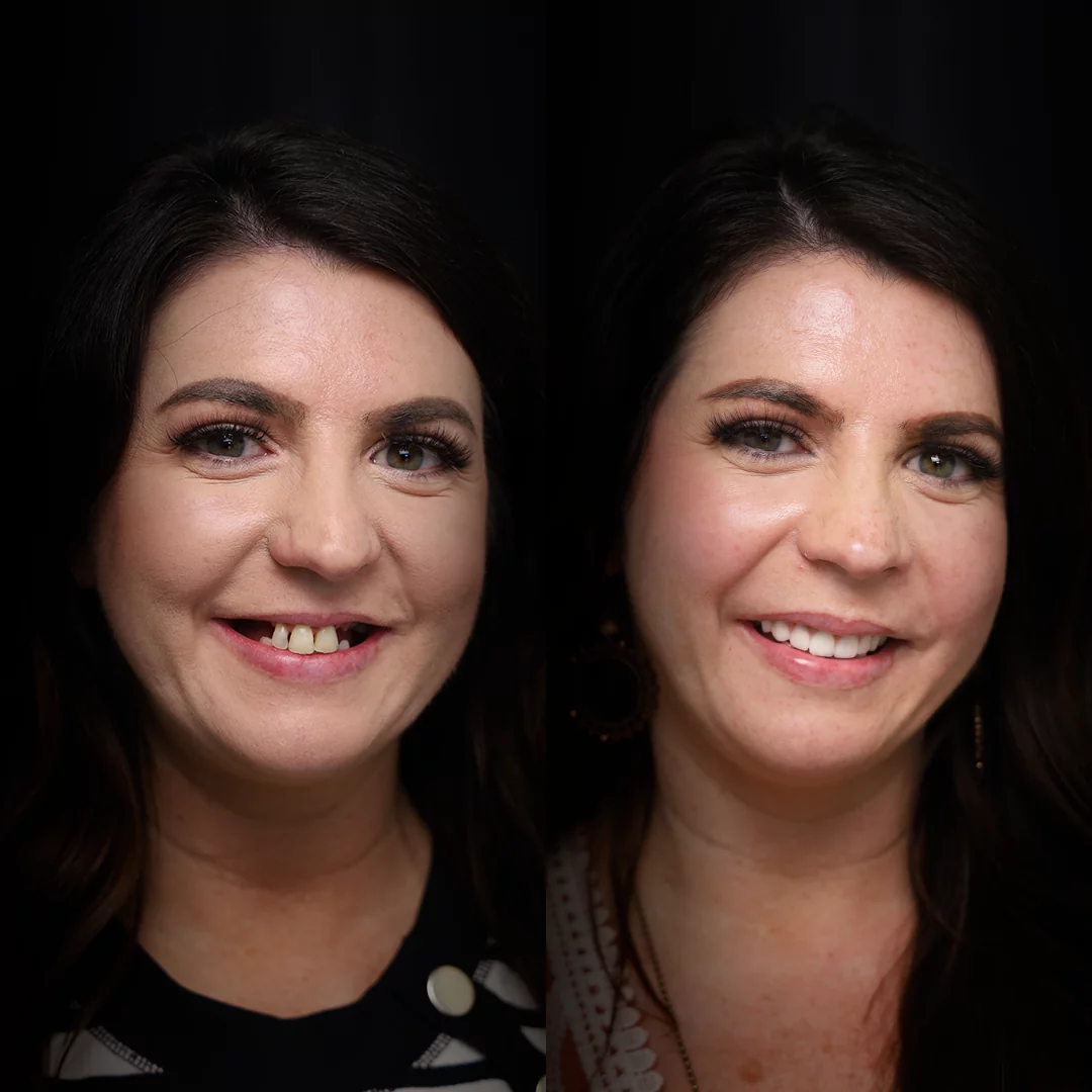 all-on-x-before-after (11)
