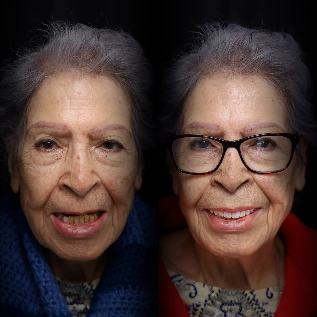 all-on-x-before-after (12)