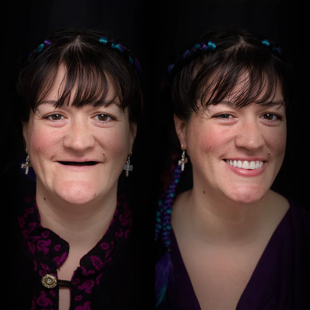 all-on-x-before-after (13)