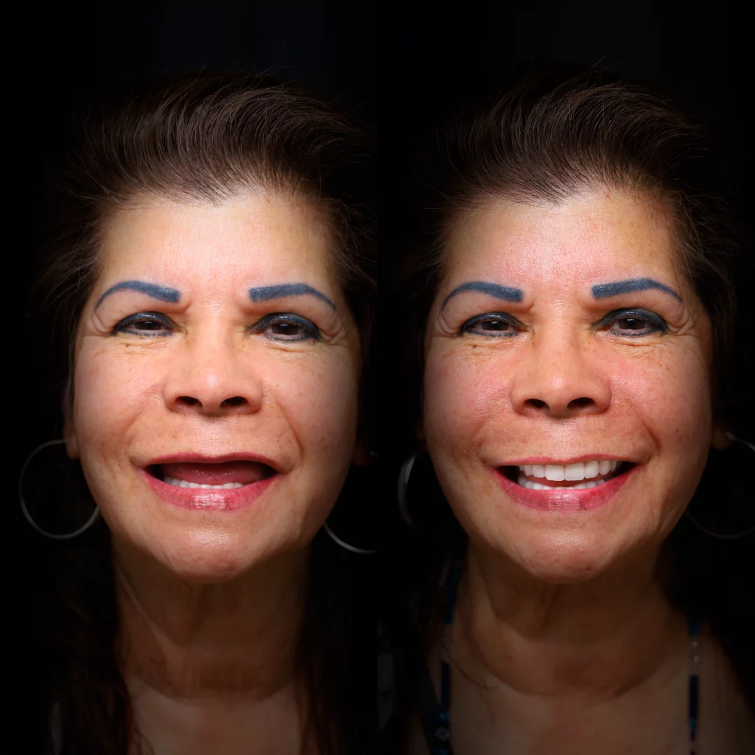 all-on-x-before-after (14)