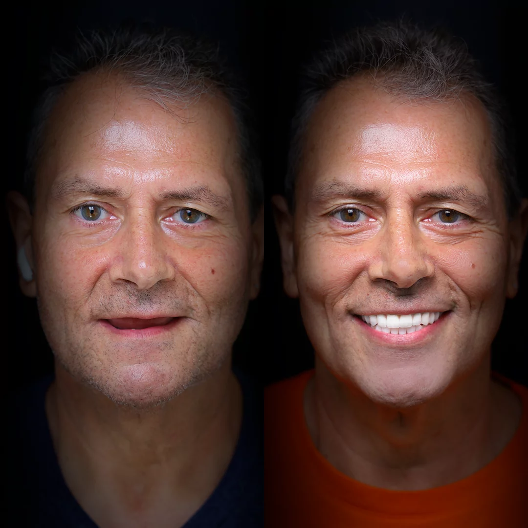 all-on-x-before-after (15)