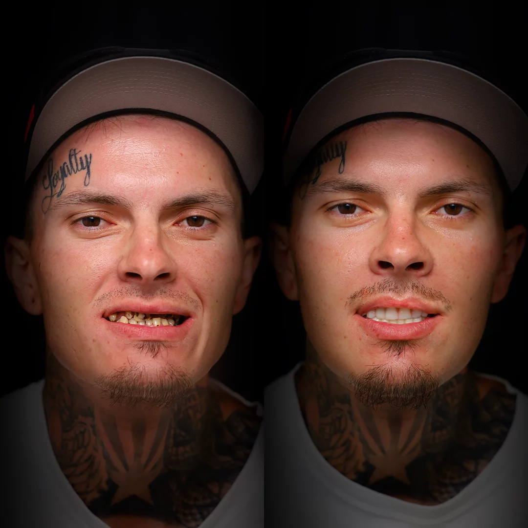 all-on-x-before-after (16)
