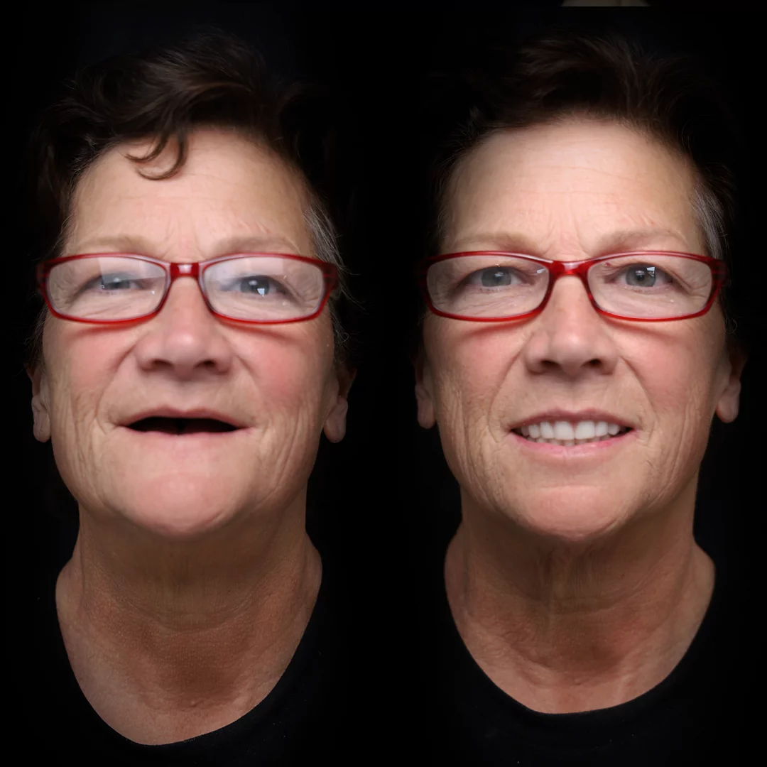 all-on-x-before-after (18)