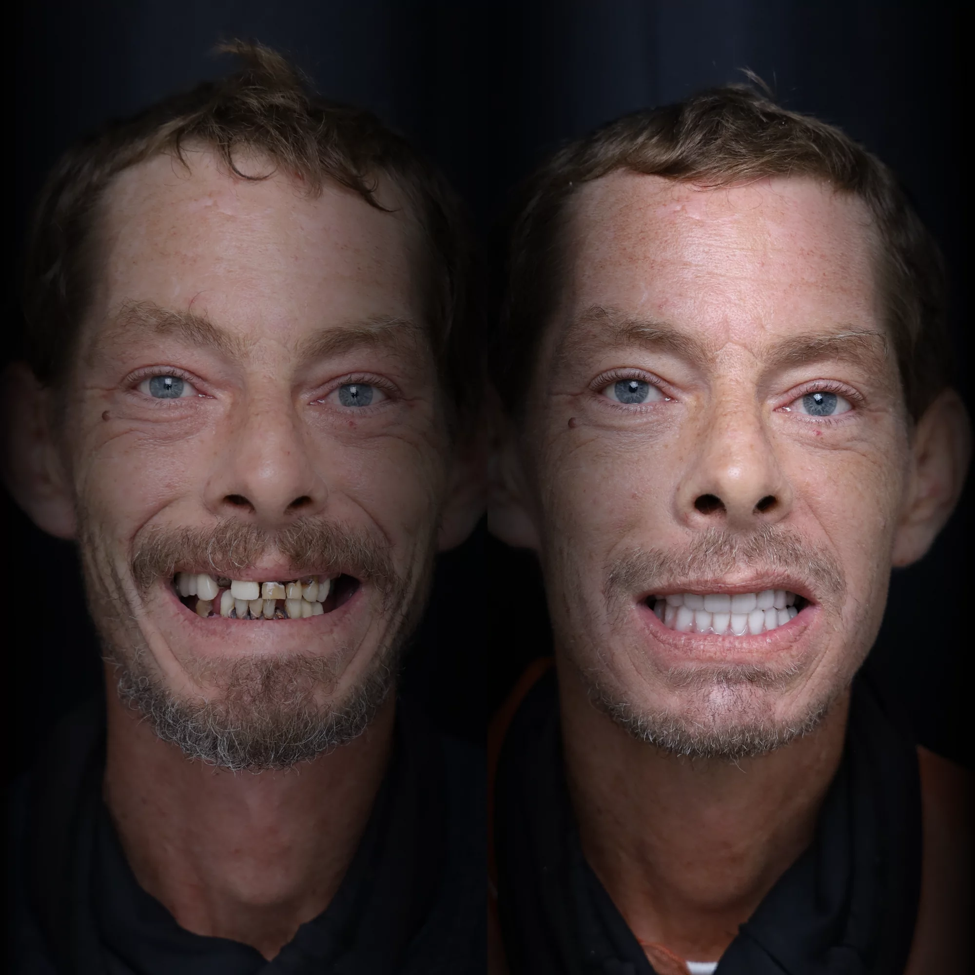 all-on-x-before-after (21)