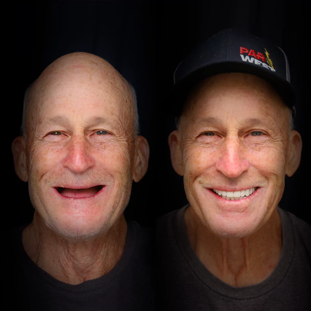 all-on-x-before-after (25)