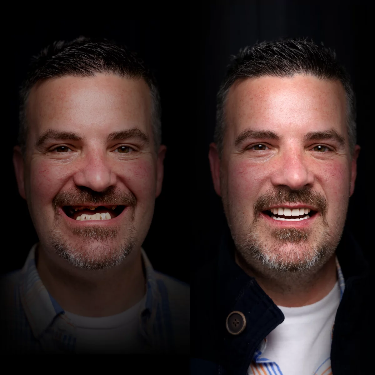 all-on-x-before-after (28)