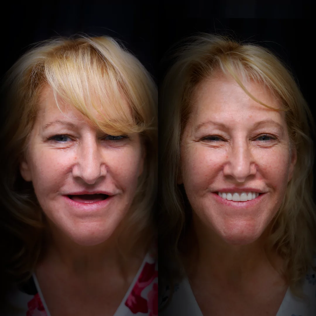 all-on-x-before-after (3)