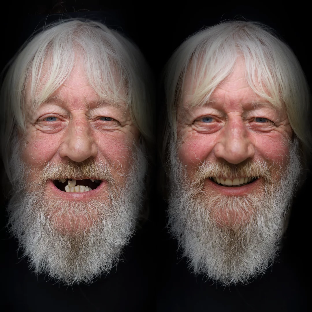 all-on-x-before-after (4)