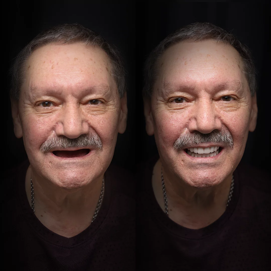 all-on-x-before-after (6)