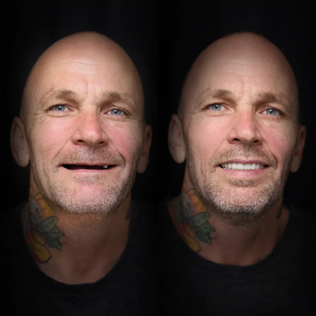 all-on-x-before-after (7)