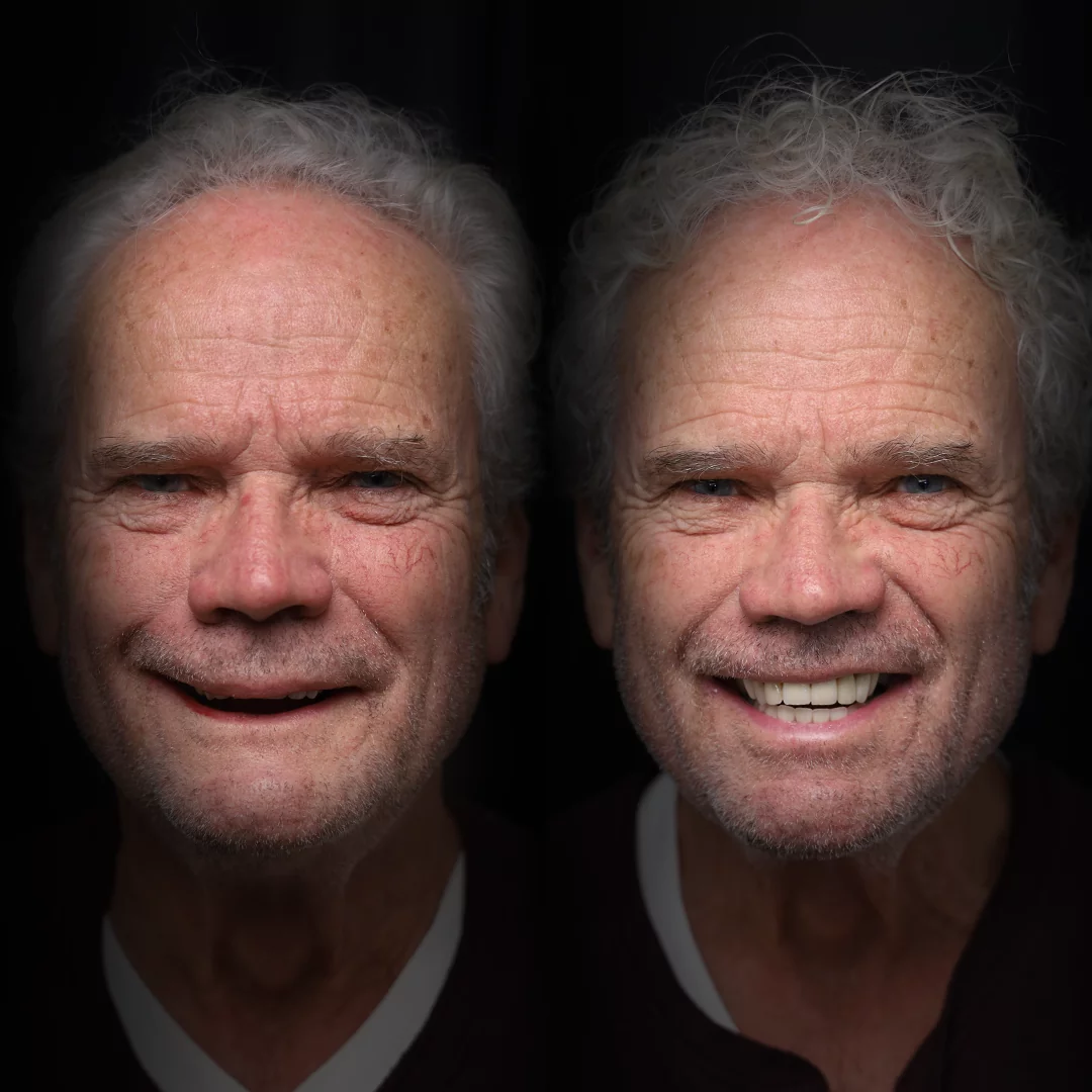 all-on-x-before-after (9)