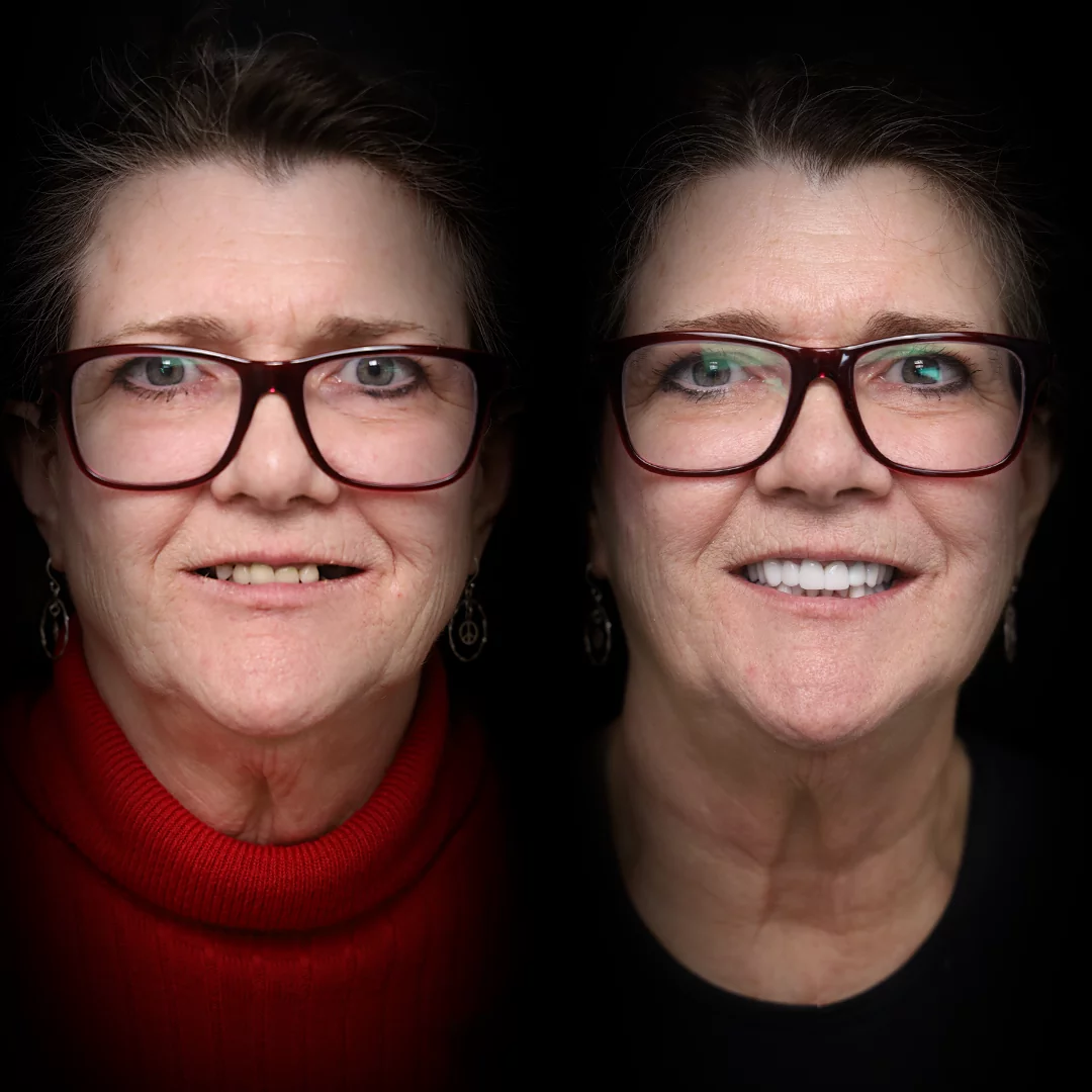 crowns-before-after (1)