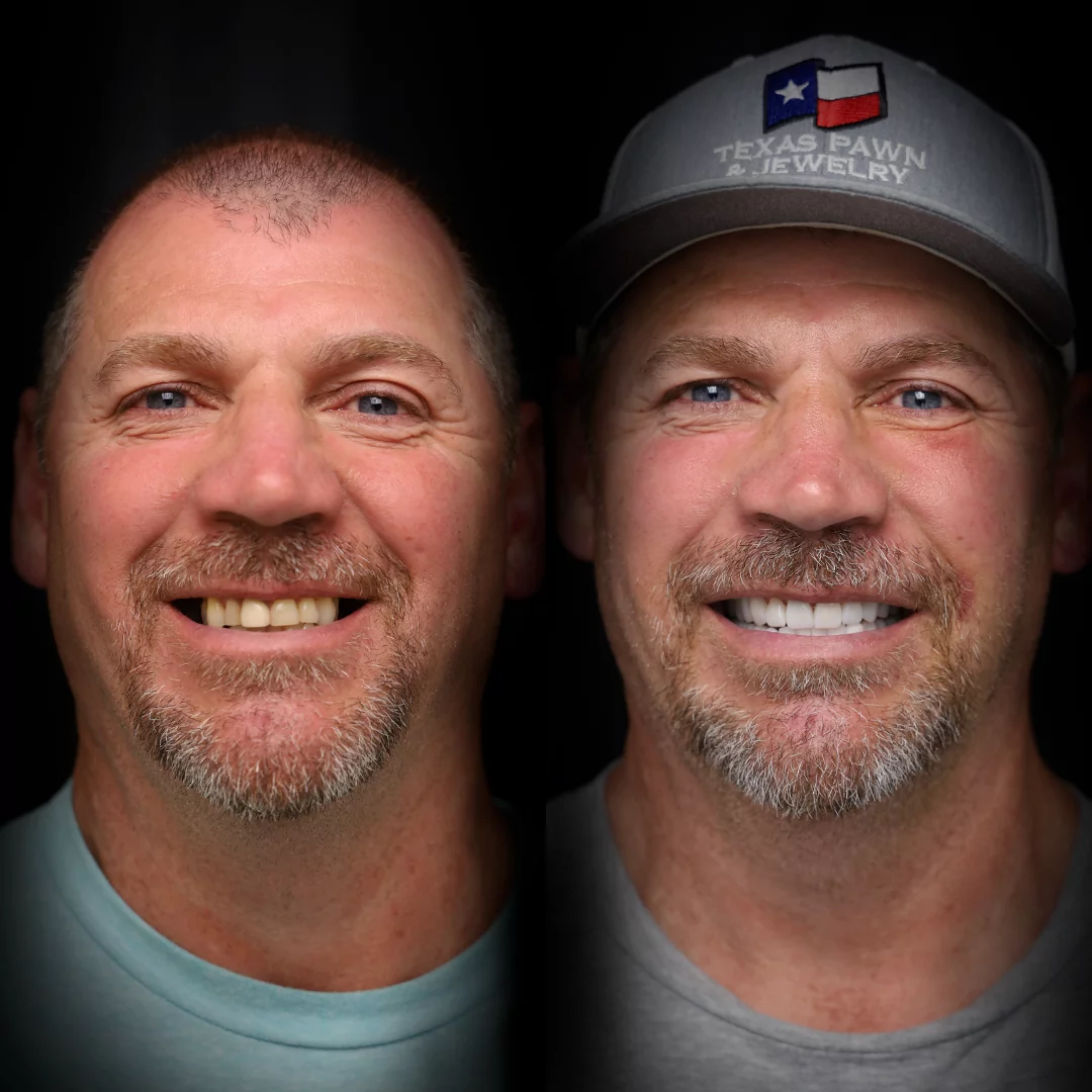 crowns-before-after (13)