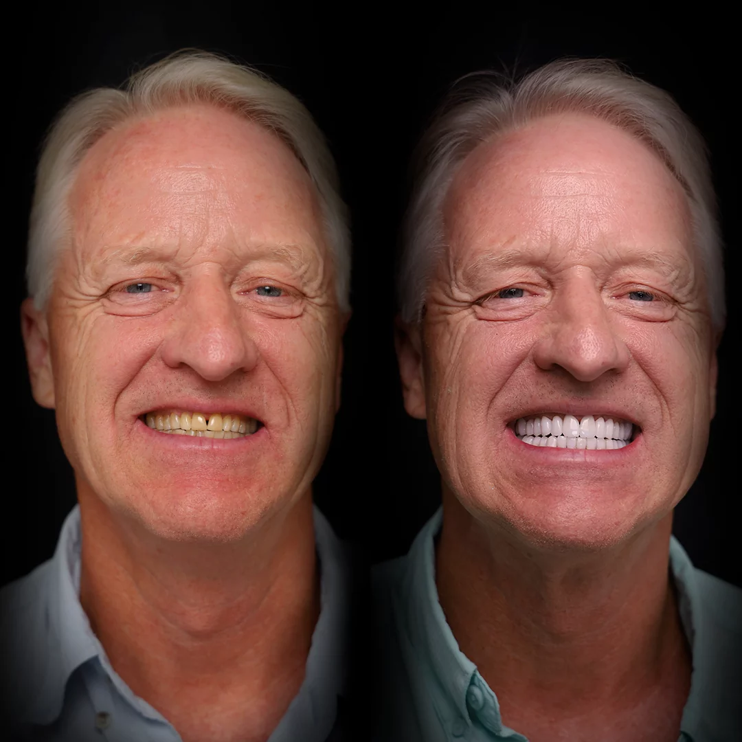 crowns-before-after (14)