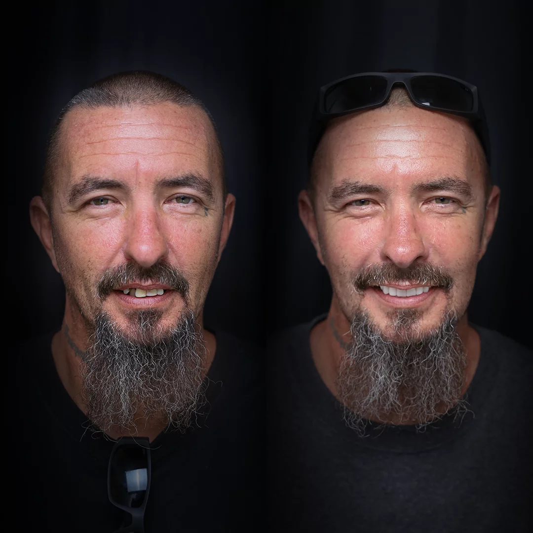 crowns-before-after (15)