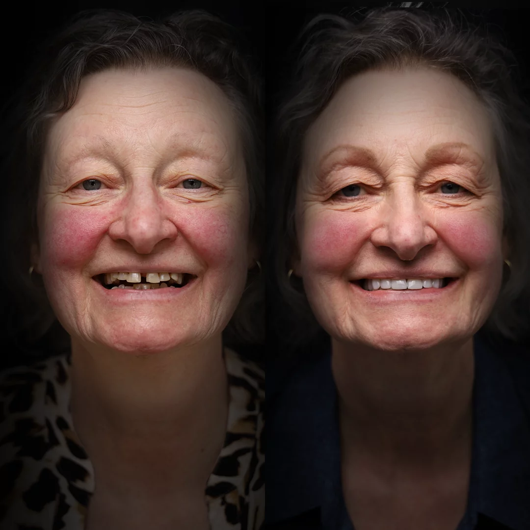 crowns-before-after (16)