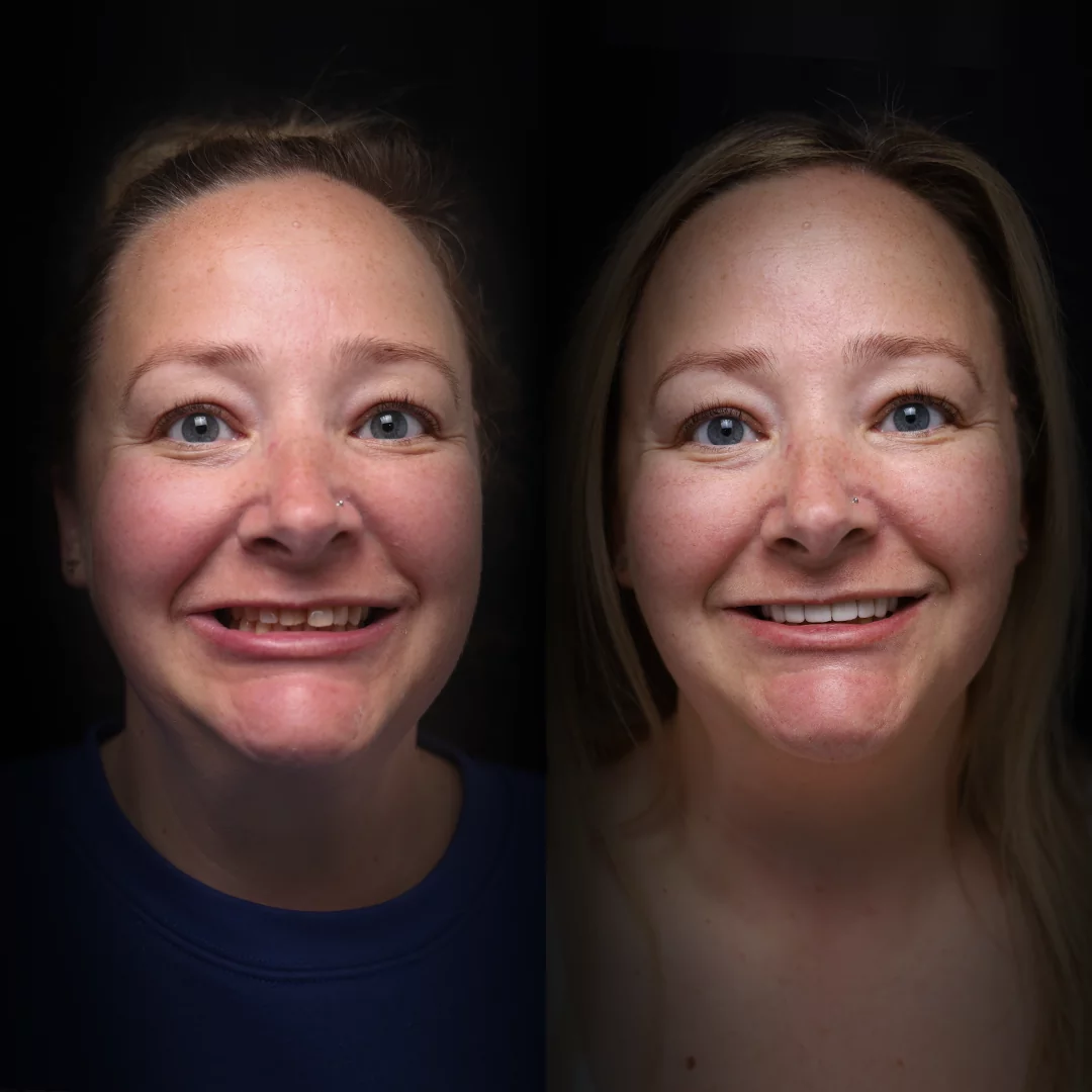 crowns-before-after (17)