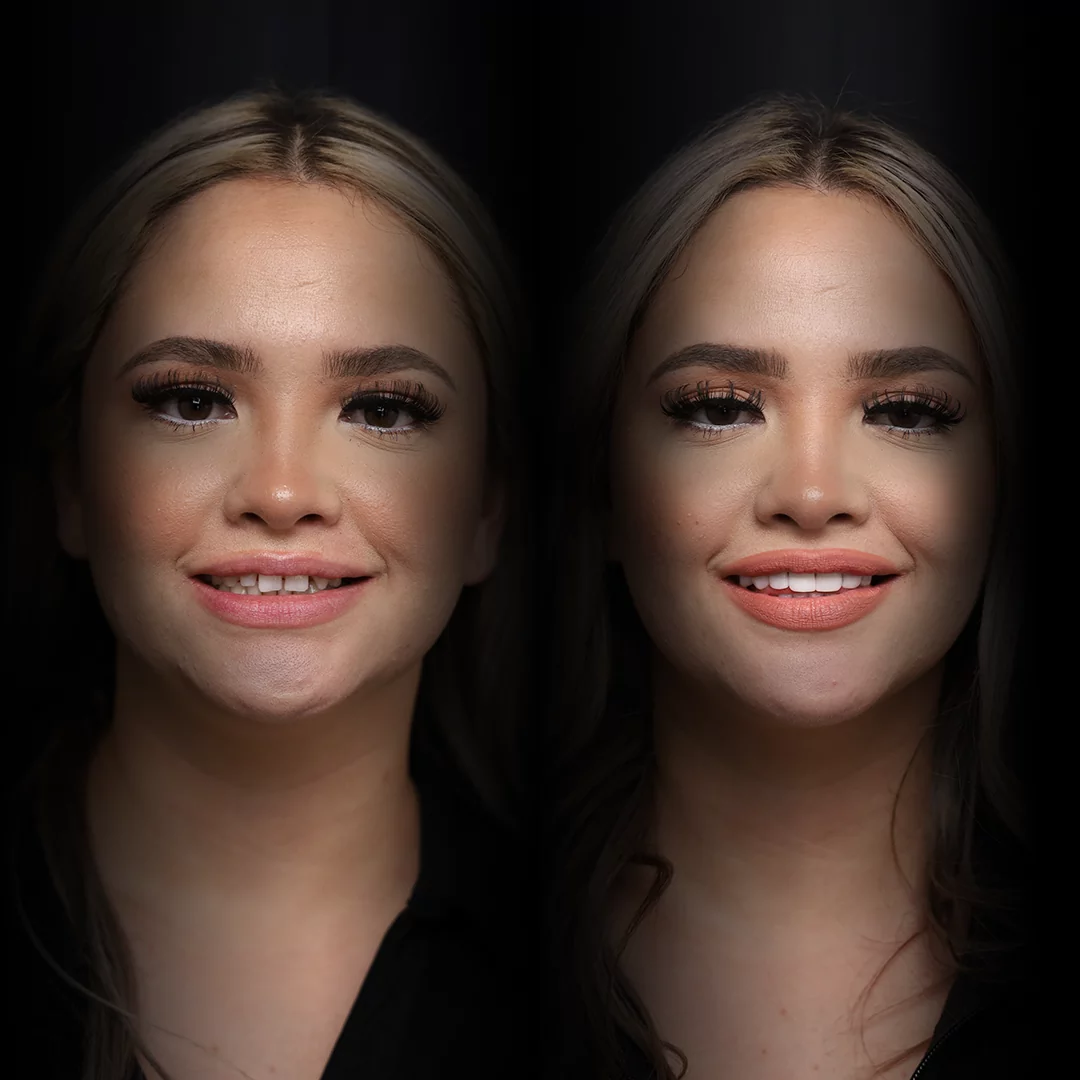 crowns-before-after (19)