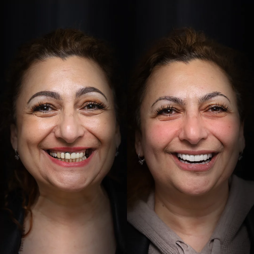 crowns-before-after (2)