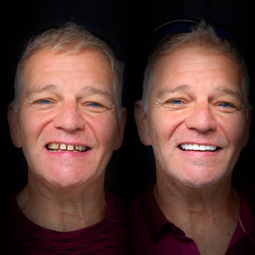 crowns-before-after (20)