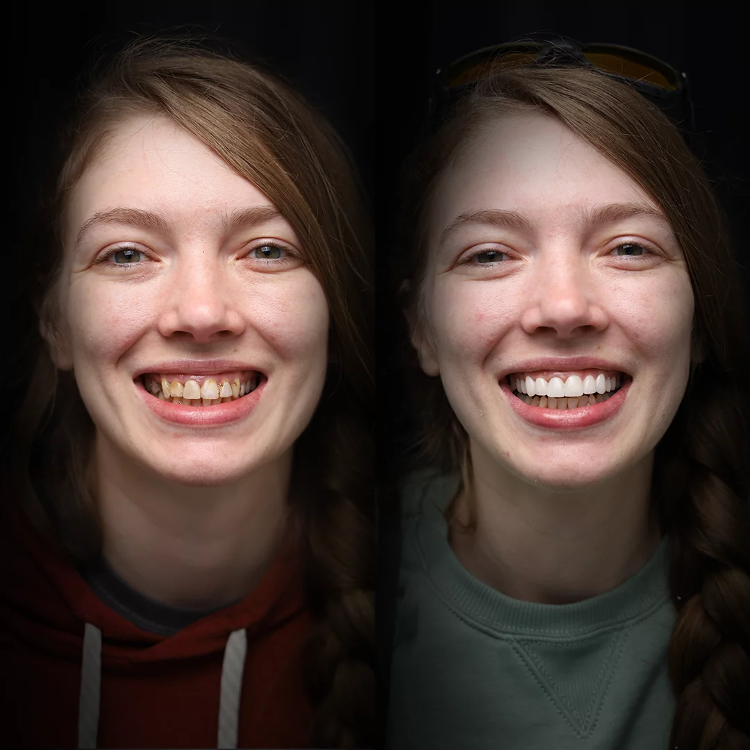 crowns-before-after (3)