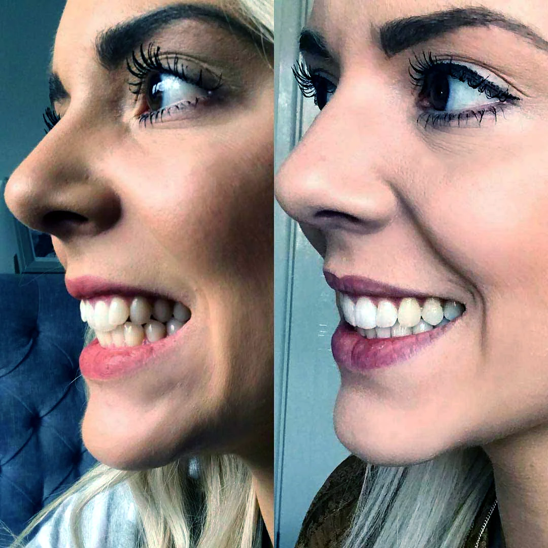 invisalign-before-after