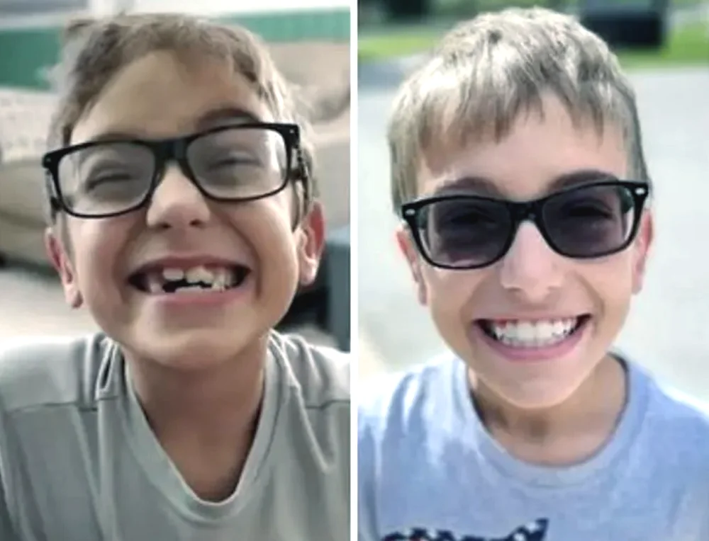 invisalign-mexico-before-after-1