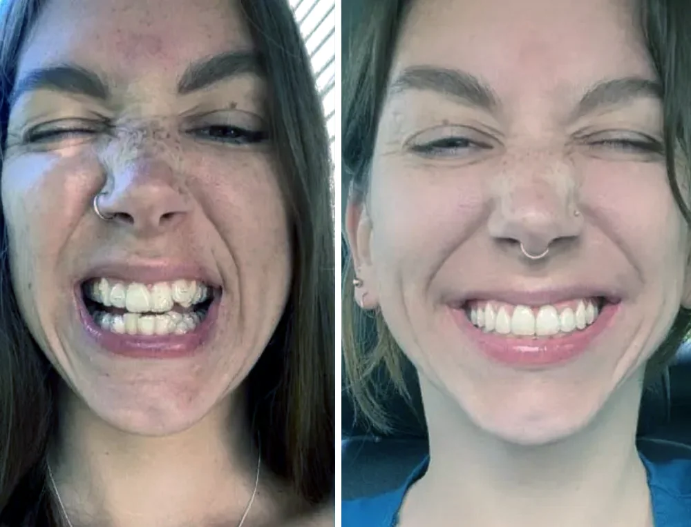 invisalign-mexico-before-after-2