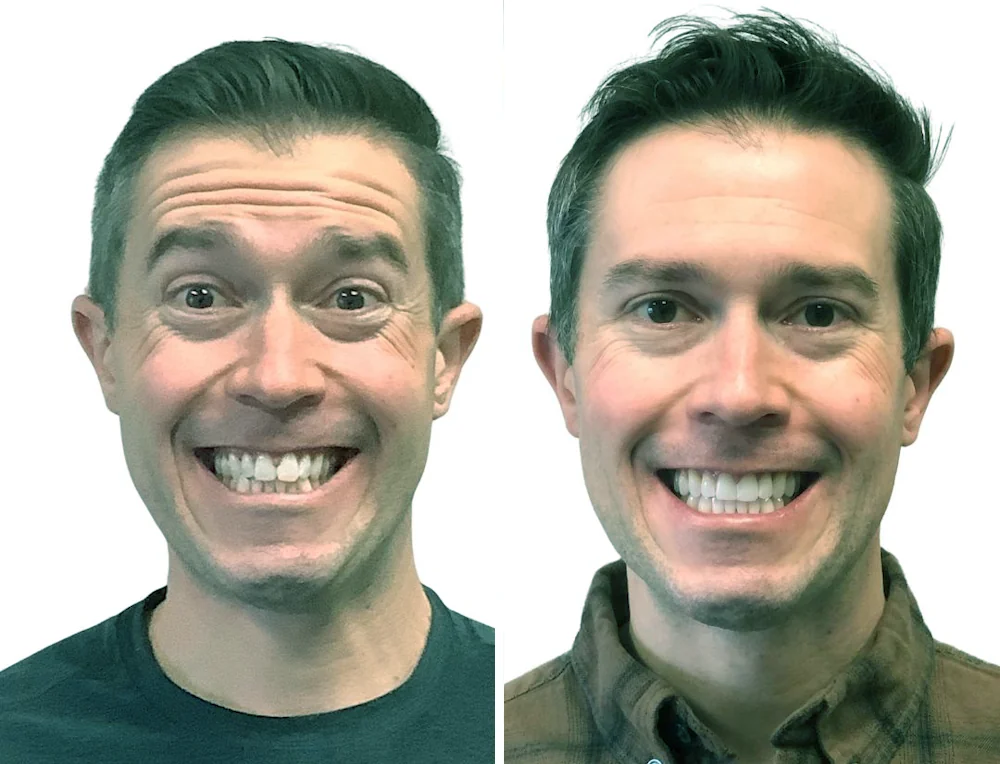 invisalign-mexico-before-after-3