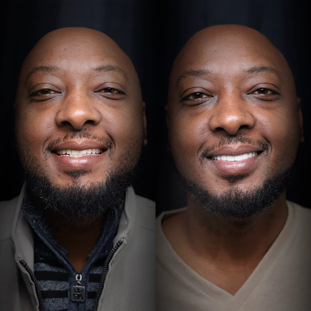 veneers-before-after (1)