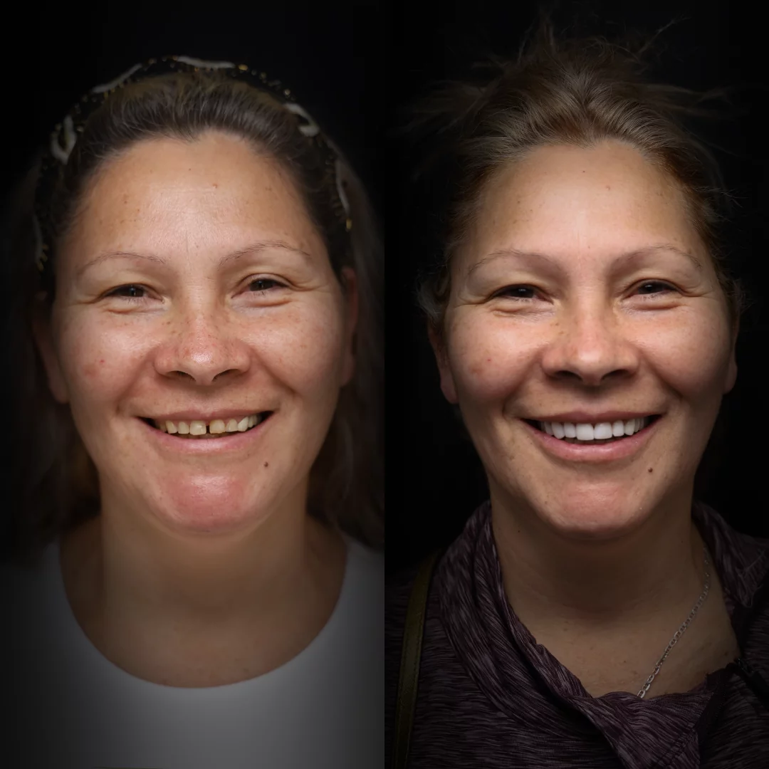 veneers-before-after (2)