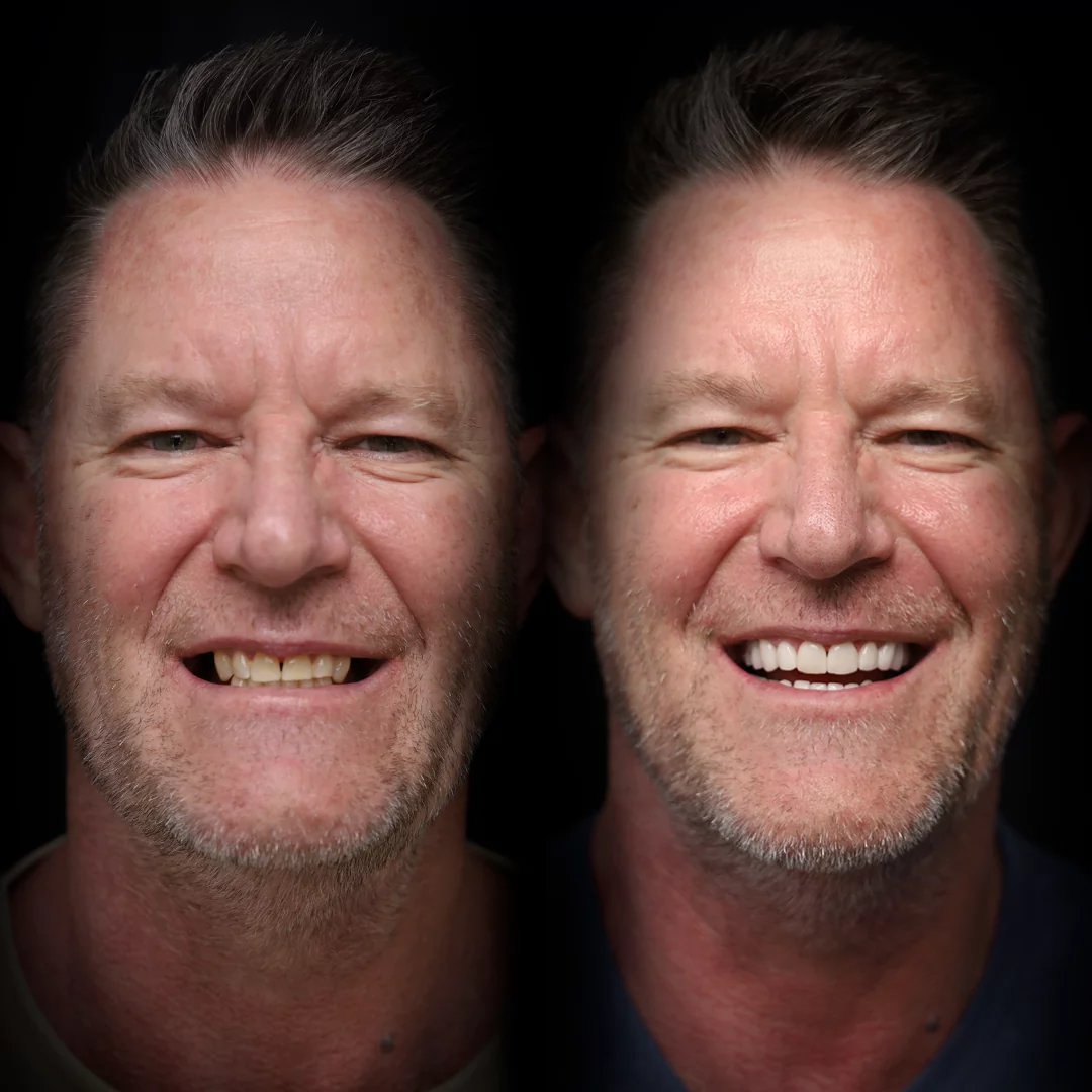 veneers-before-after (3)