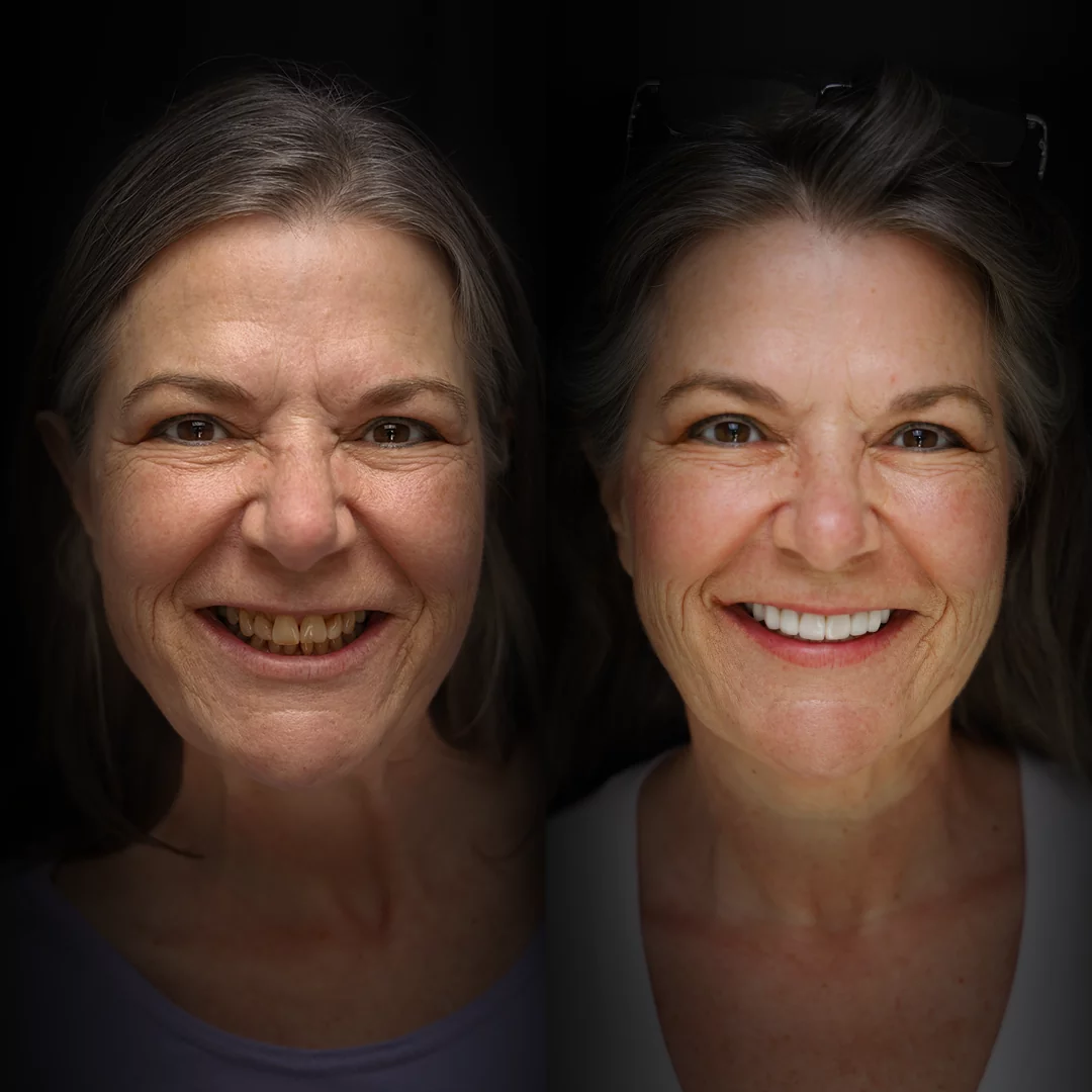 veneers-before-after (5)