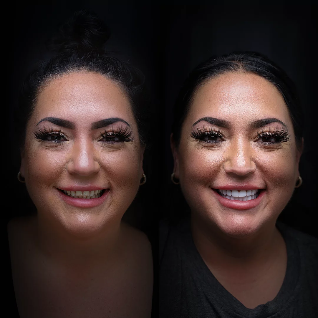 veneers-before-after (6)