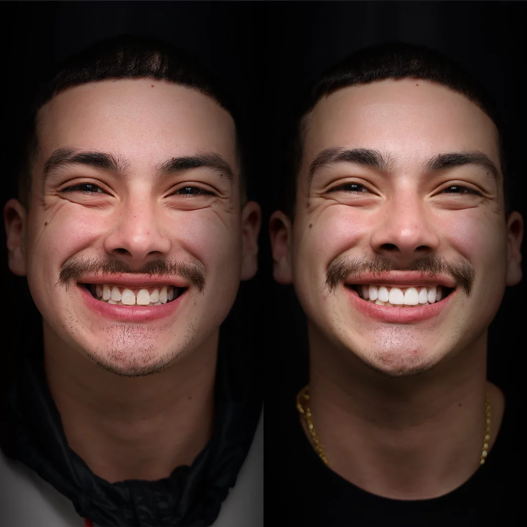 veneers-before-after (7)