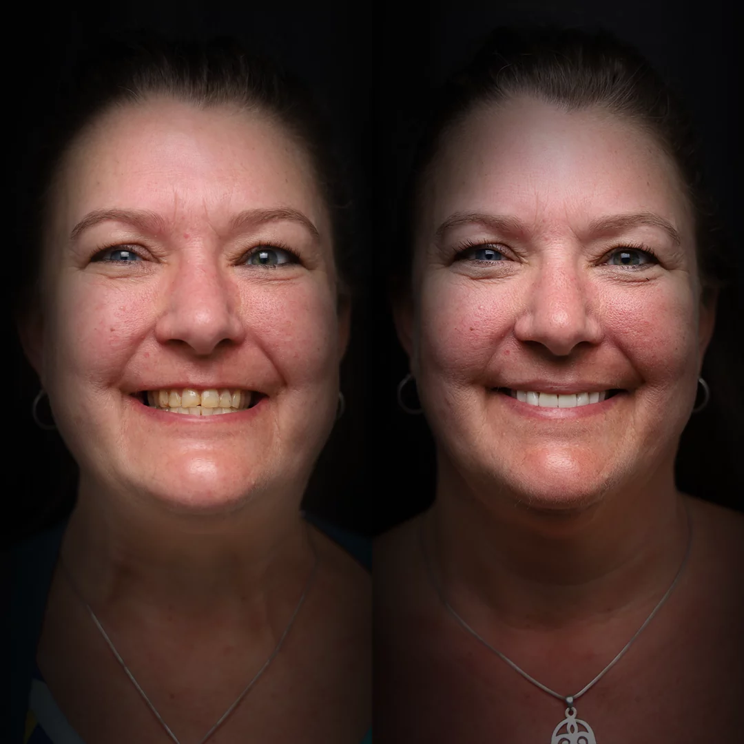 veneers-before-after (8)